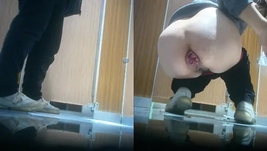 Super big hemorrhoids as big as a fist